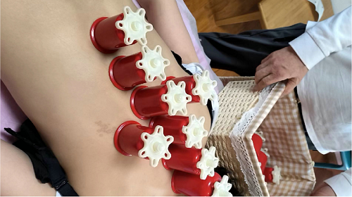 百川健康，拔罐